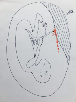 孕妇遭遇车祸 胎儿"拉扯"脐带"自卫"奇迹生还