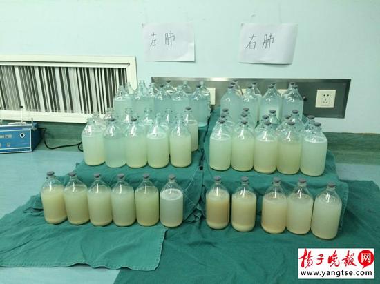 市民呼吸衰竭 肺里洗出来90瓶“牛奶”(图)_新浪安徽_新浪网