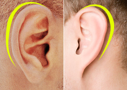 左侧耳朵“护栏”明显；右侧不明显