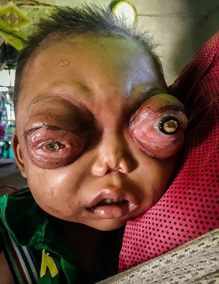 印2岁男童患眼癌 眼球外凸似怪物