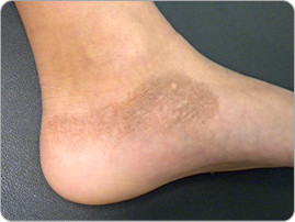 上图是脚擦伤后，出现的皮肤颜色加深，图片来自http://www.aboutkidshealth.ca.