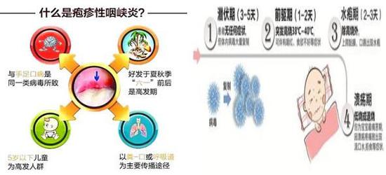 图2疱疹性咽峡炎的发病特点