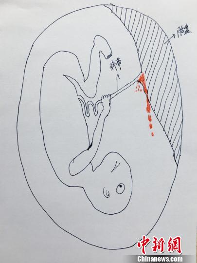 图为医生手绘的示意图。　许有江　摄