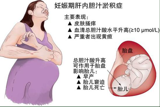 源于美国孕妈的警示:哪种孕期皮肤痒,可能毁了宝宝! 据