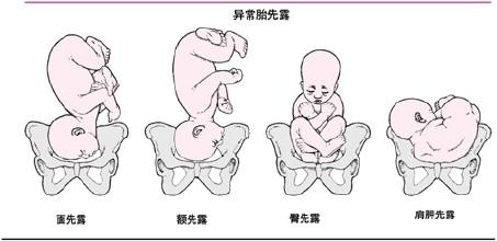 胎位不正别坐等剖腹产 方法用对可纠正过来顺产第1张