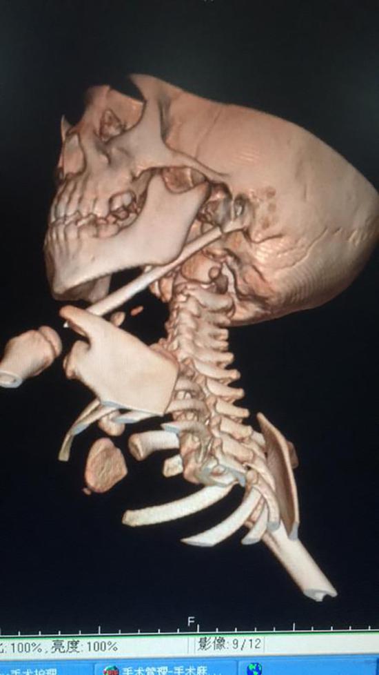 CT显示，这根筷子直达左侧颅底颈静脉球大血管，情况十分危急。