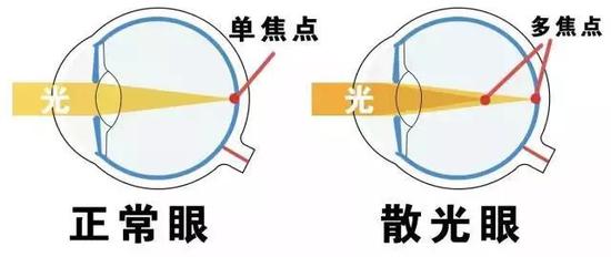 弱视、头痛、咪咪眼……从出生到学龄前，娃散光问题千万不可忽视!