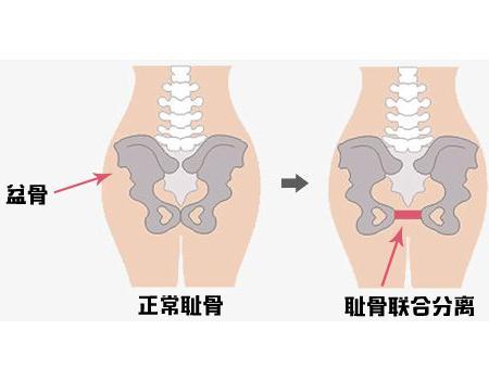 看着图，小于问：“哎呀，是这样的呀，好端端的耻骨怎么会被分开了呢？”