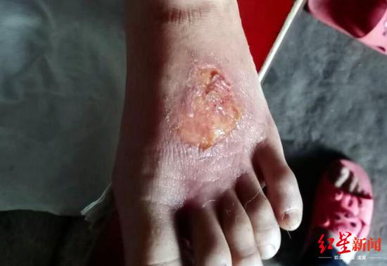 网帖中发出的女孩伤情 网络截图