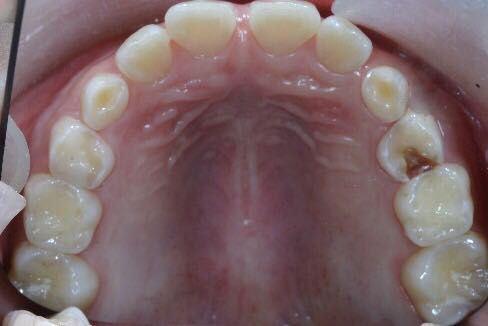 图2 牙齿酸蚀症和龋齿