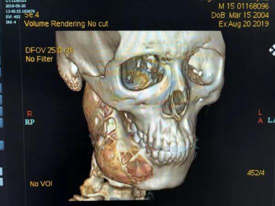 颌骨3D-CT显示