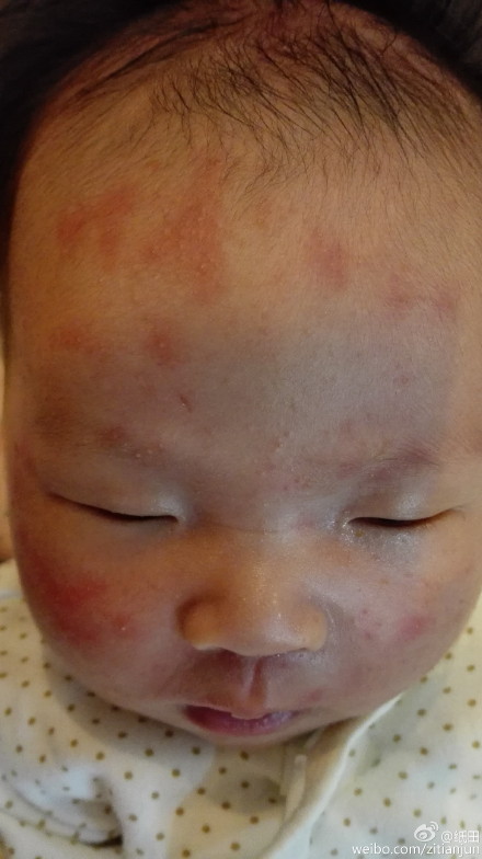 宝宝脸上头皮起了有白脓包的疹子怎么护理?_