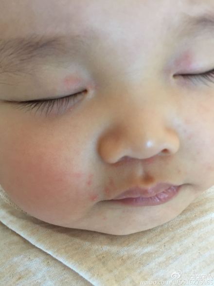宝宝脸上起了好多疹子怎么治