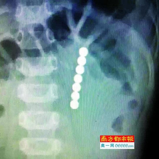 1岁半宝宝误吞7颗磁珠险致命|误食异物|消化道