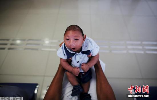 巴西寨卡病毒肆虐下的小头症宝宝。