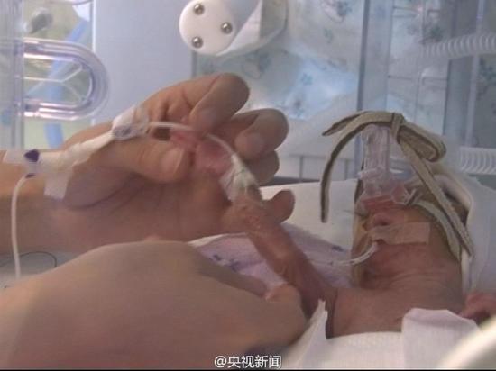 江苏女婴豆豆，在母亲体内只待了6个多月就出世了，仅重630克。胳膊只有成人的手指大小。
