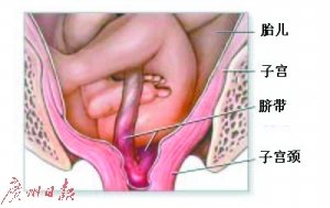 屡上头条的脐带脱垂究竟是啥?|孕妇|胎膜|脐带