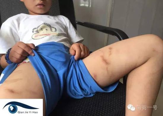 孩子大腿内侧疑遭铁钳拧夹的伤痕