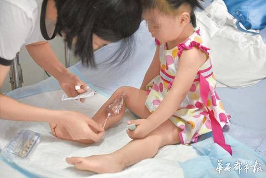 28 日,右脚被电伤的语语(化名)在成都第二人民医院烧伤科接受治疗。