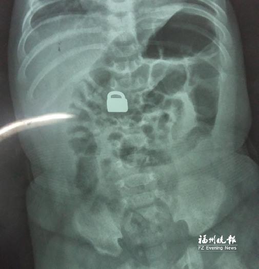 7.25龙岩当地医院拍的X光片显示，平安锁在宝宝体内。
