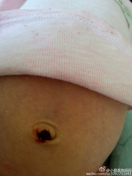 新生宝宝肚脐流血怎么处理?|鲍秀兰|护理|肚脐