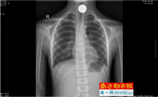 8岁女童贪玩误吞硬币卡在食道。南都记者 何永华 摄