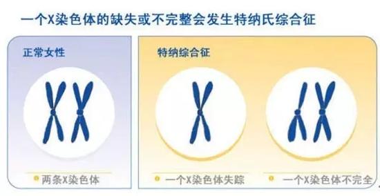体检发现心包积液,几经排查发现竟是缺了一条X染色体