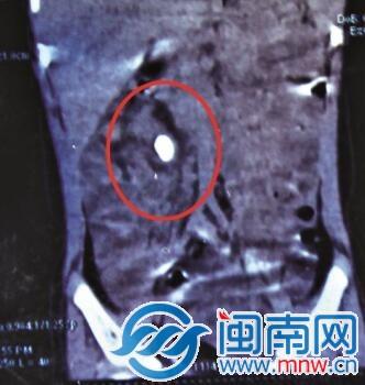 小依的右肾长了个不小的结石(画圈处)