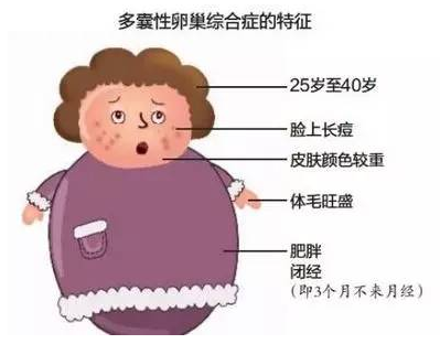 女子婚后皮肤变糙长胡须经查系卵巢多囊或不孕