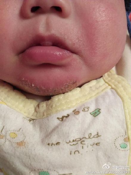 宝宝最近长了这个是什么(图)