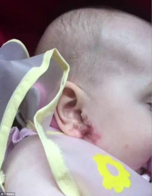 澳大利亚珀斯的宝宝Bonnie，在6个月大的时候耳朵上长了一个小包。