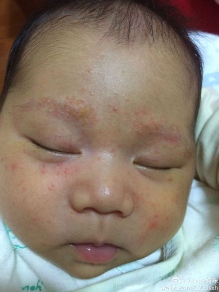 宝宝脸上长了好多疹子怎么回事(图)