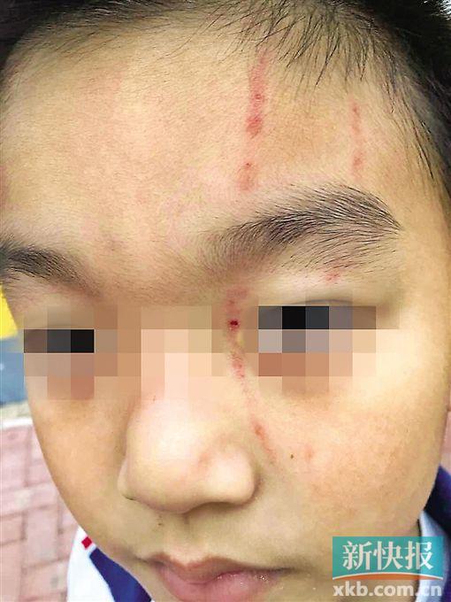 小伟脸上的伤痕清晰可见。 受访者供图