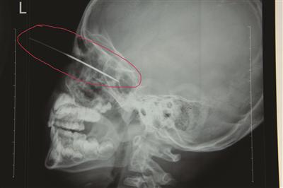 钢丝插进3岁男童头部5厘米。朱鼎兆 摄