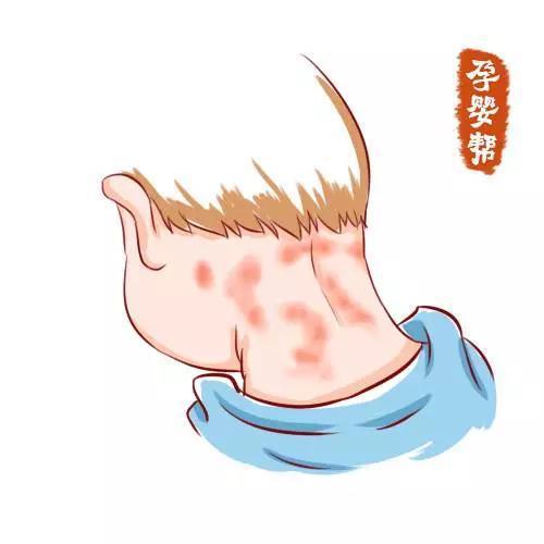 宝宝常见的7种皮肤疾病,一些该做不该做的要小