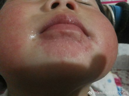 宝宝一喝奶下巴就红红的怎么办?