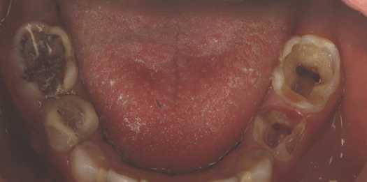 宝宝满嘴烂牙，妈妈们忘了做这件事!|宝宝|龋齿_新浪育儿_新浪网