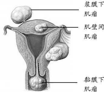 子宫肌瘤示意图