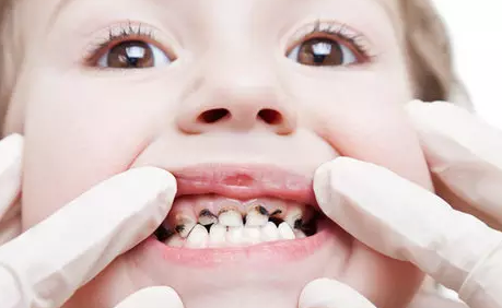 乳牙为何易患龋齿?|龋齿|乳牙|奶瓶