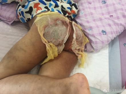 双手烫伤屁股被打烂全身淤青