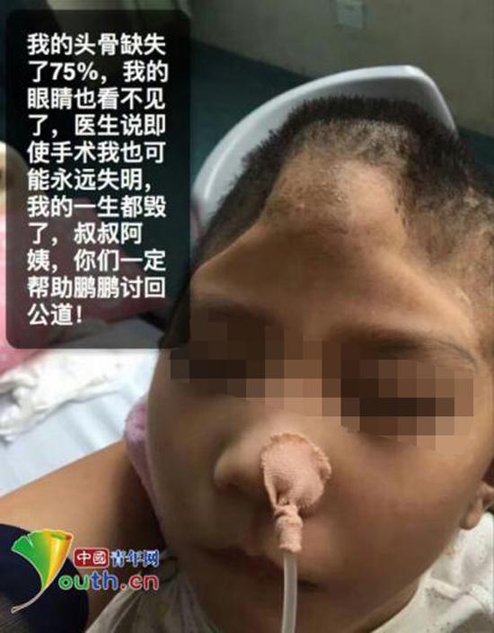 被虐待男童头骨损掉75%,眼睛也看不见了。 @呼唤鹏鹏 图