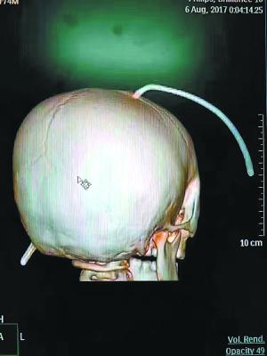 钢筋贯穿男童的脑袋。