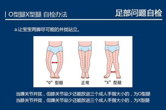 O型腿 X型腿检测办法