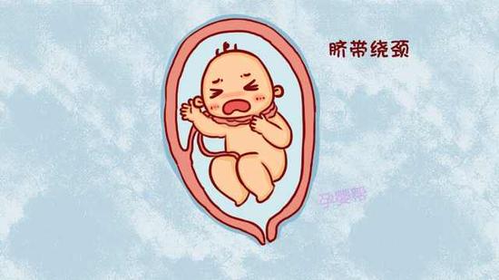 避免胎儿脐带绕颈，孕期4件小事做不得!|脐带|胎儿|子宫_新浪育儿_新浪网