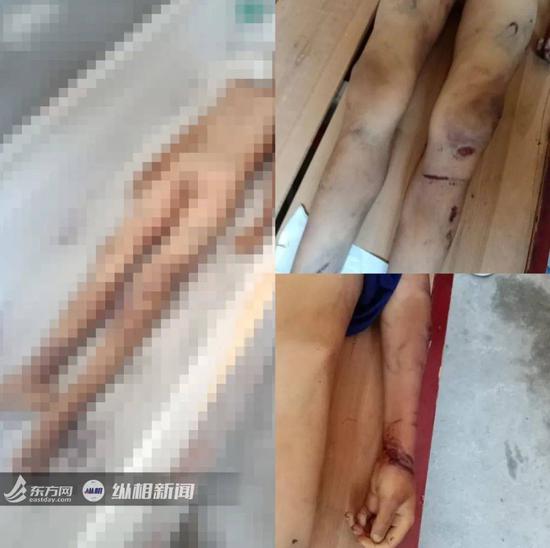 事发后张永健拍下的康康身上的伤痕。  本文图片 纵相新闻微信公号