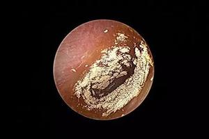 给孩子的耳朵滴液或软膏你真的会吗？