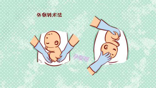 怎么才算胎位不正 3wcL-hhzsnea1721672.jpg