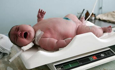 山东一产妇产下12.9斤巨婴