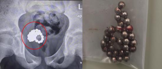 医生从11岁男童体内取出的磁力珠。上海交大医学院附属新华医院 供图