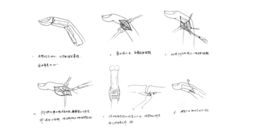 郭宗慧所绘的手术示意图